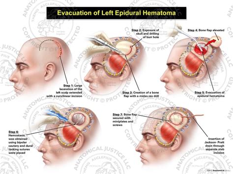 Evacuation Of Left Epidural Hematoma