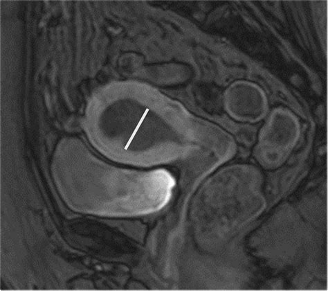 Accuracy Of Transvaginal Ultrasound Versus Mri In The Preoperative Diagnostics Of Low Grade