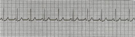 EKG Exam 1 Flashcards Quizlet