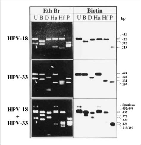 Typing Of HPV By RRFLP Analysis Of Clinically Derived Exfoliated