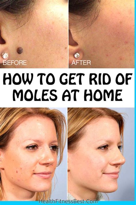 How To Remove Moles From Face Quickly Howtoermov