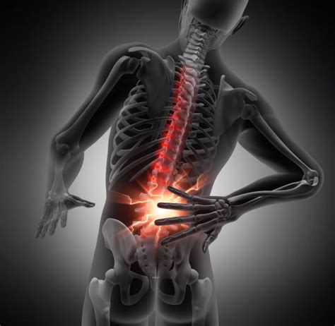 Low back fracture injuries | Atlanta Injury Law Blog