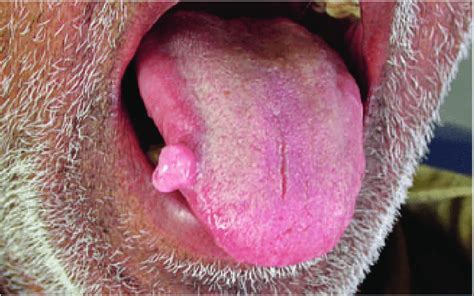 Fibroma Tongue