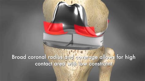 Custom Total Knee Replacementresurfacing By Conformis Youtube