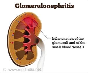 Glomerulonephritis Diagnosis