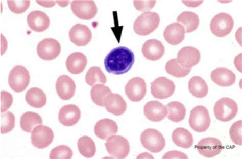 The peripheral blood smear is from a 46 year old | Chegg.com