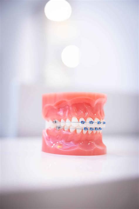 Before and After Braces Face Shape — Shoe Orthodontics Hanover, PA