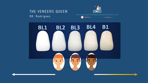 How To Select The Right Shade ⋆ Veneers Ced