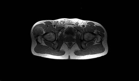 Soft Tissue Sarcoma Mri Radiology Article On Soft Tissue Sarcoma Mri