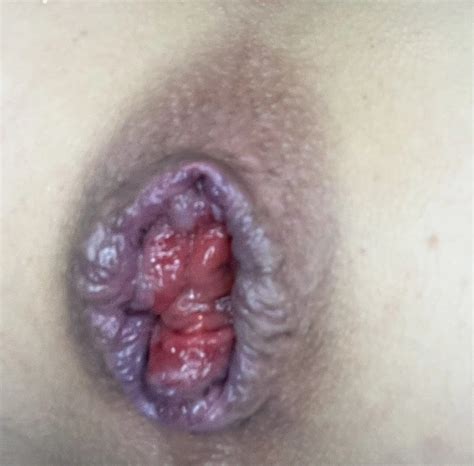 StaceyLovesAnal Stretched Hole 20 Nude Pics XHamster