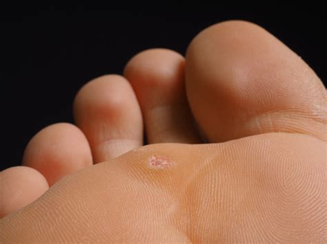 4 Common Foot Skin Problems And Treatments Foot And Ankle Group