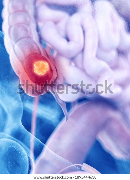 1,074 Metastasis Colon Cancer Images, Stock Photos & Vectors | Shutterstock