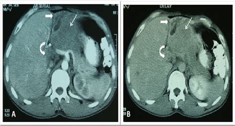 Abdominal Ct Scan With Iv And Oral Contrast A Arterial Phase B Download Scientific