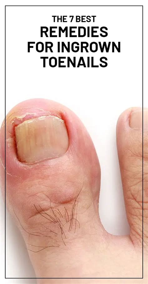 The 7 Best Remedies For Ingrown Toenails