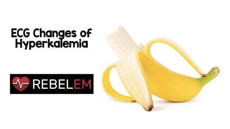 ECG Changes of Hyperkalemia - REBEL EM - Emergency Medicine Blog