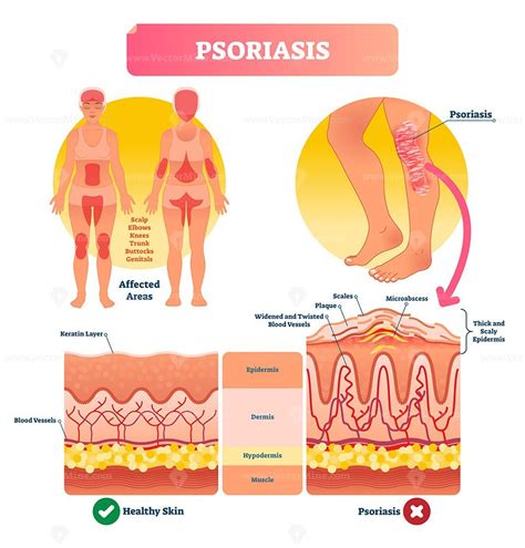 Psoriasis vector illustration - VectorMine