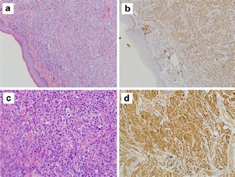 Representative Images Of Primary Or Metastasized Melanoma H E