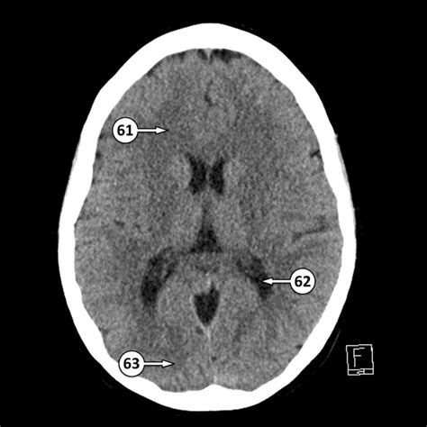 Mri Brain Ventricle Anatomy