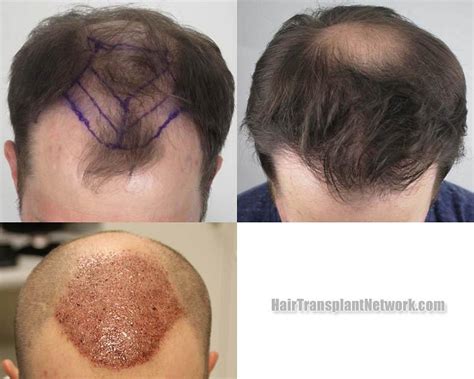 Dr H Rahal Hair Restoration Surgery Before And After Result Photos