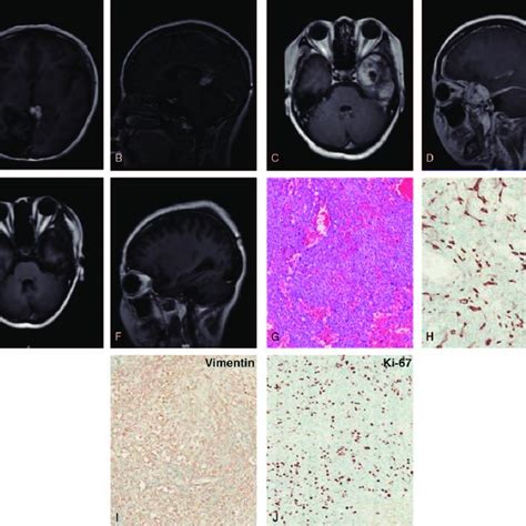 MRI Scanning And Pathological Analysis Of The Solitary Fibrous Tumor In