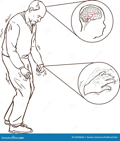 Parkinson Symptoms Stock Illustrations – 253 Parkinson Symptoms Stock