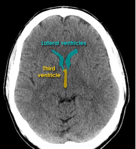 Lateral Ventricle Ct Scan