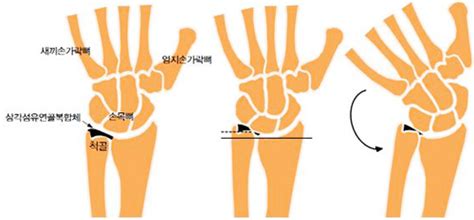 닥터 송의 건강상담실 척골충돌증후군