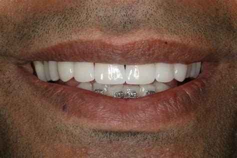 Case 6 Veneers And Smiles Makeover Before And After Gallery