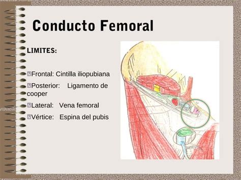 Hernia Inguinal Y Femoral