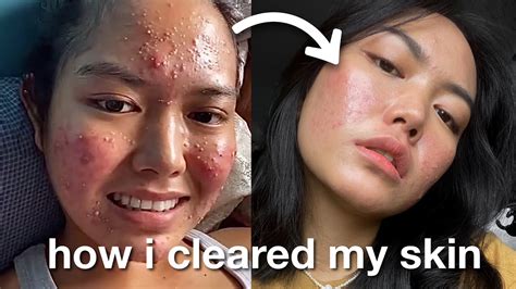 10 Tips To Get Clear Skin How I Cured My Cystic Acne Youtube