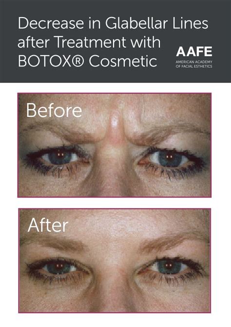 7 best Botox: Before and After images on Pinterest | Botox cosmetic ...