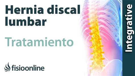 Tratamiento De La Hernia Discal L5 Y S1 Izquierda O Quinta Lumbar Y Sacro Fisioonline