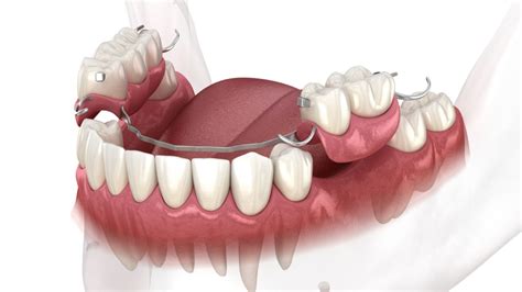 Ponte Móvel 2 Dentes RETOEDU