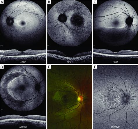 Retinal Imaging Of Rod Cone Dystrophies A Autosomal Dominant