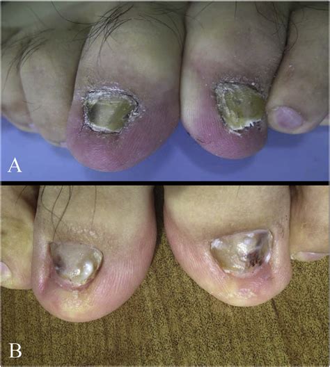 A Toenails Affected By Onychomycosis B Two Months After Initial