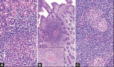 Signature Of Castleman Disease In Gastrointestinal Mucosal Biopsies And