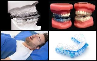 Oral Appliances For Snoring And Sleep Apnea