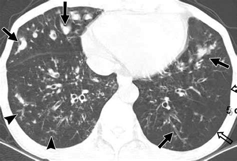 bilateral bronchiectasis  bronchiolitis  thin section ct