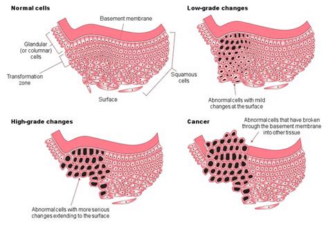 Best 25+ Cervical cancer stages ideas on Pinterest | Stage 3 ovarian ...