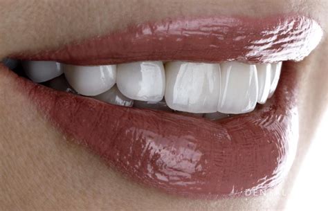 Cómo Conseguir La Sonrisa Perfecta Con Carillas Dentales De Porcelana