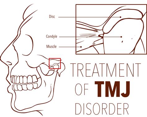 Can Wisdom Teeth Cause Tmj Boston Dentist Congress Dental Group