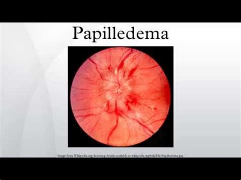 Papilledema - YouTube