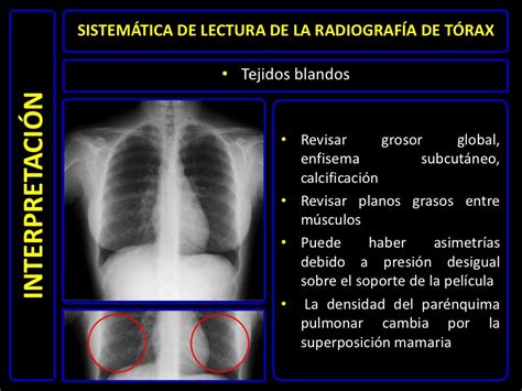 Diagnóstico Por Imágenes Radiografía De Tórax Normal