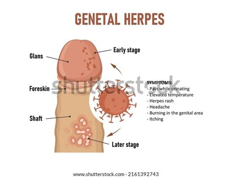 Genital Herpes Herpes Simplex Virus Stock Vector Royalty Free