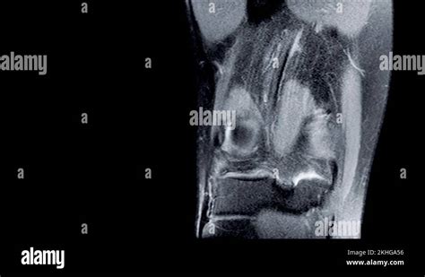 Magnetic Resonance Imaging Mri Of Right Knee Closed Injury Of The