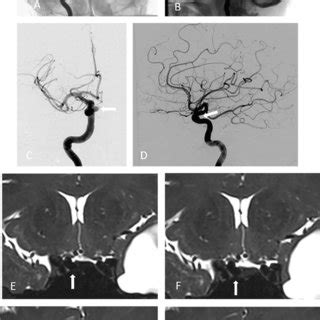 Cerebral Digital Subtraction Angiography Dsa Of Intracavernous