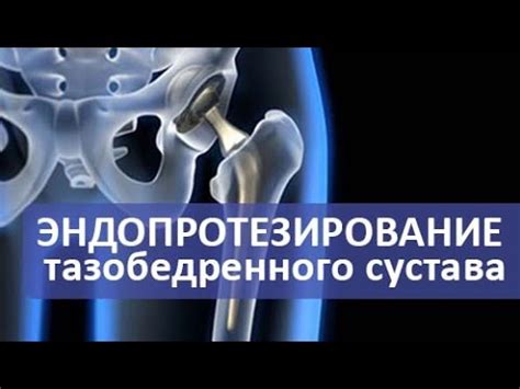 Эндопротезирование тазобедренного сустава. Операция эндопротезирования ...