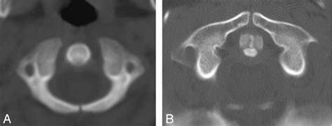 Structure Of Sphenooccipital Synchondrosis Semantic Scholar