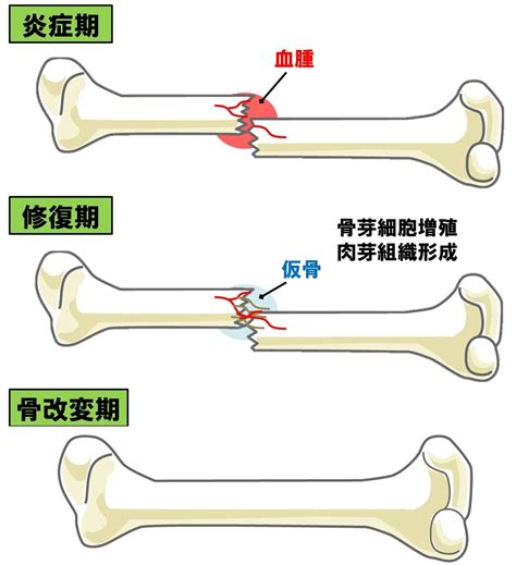 【基礎から学ぶ】骨折の治癒機転【整形外科学】 Ptot国家試験対策ブログ