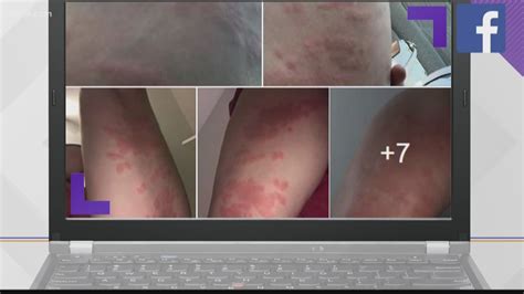 St. Pete bar responds to customer rash infection concerns | wtsp.com